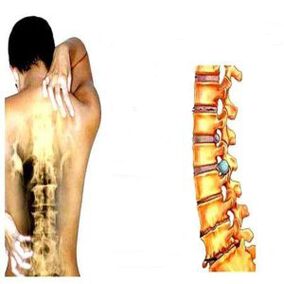 Etapas de la osteocondrosis