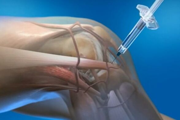 Inyección intraarticular de articulaciones de rodilla