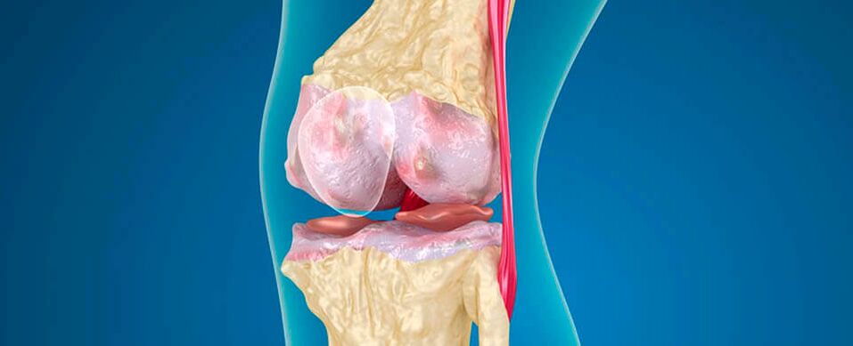 artritis de rodilla