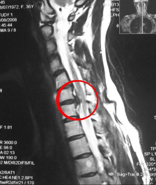 Síntomas de osteocondrosis del tórax en una radiografía. 